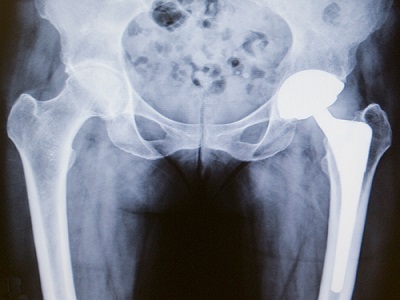 Total Hip Replacement